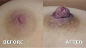 Watch video sex Inverted Nipple Correction Audio Testimonial Photos Aurora Clinics Mp4 online