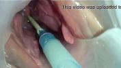 Video sexy Sperm injected into the uterus of the wife of others online high quality
